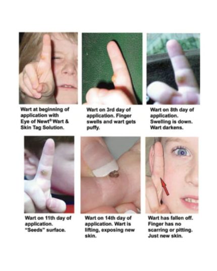 wart remover